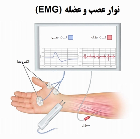 نوار عصب و عضله
